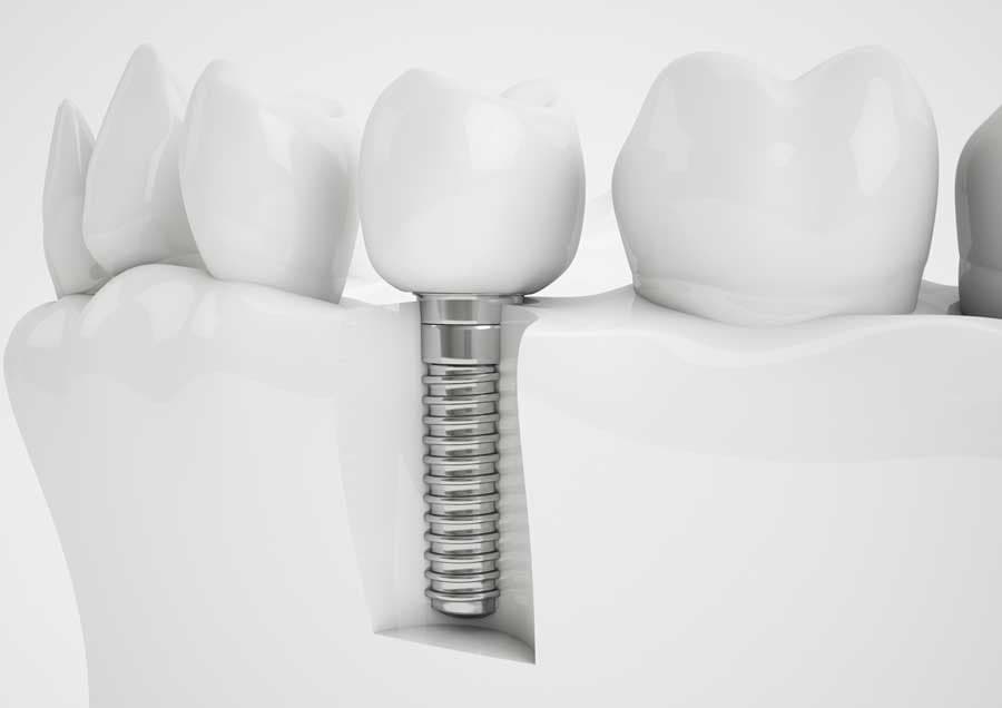 Single dental implant illustration