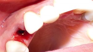 Dental Implants Post Operative Care